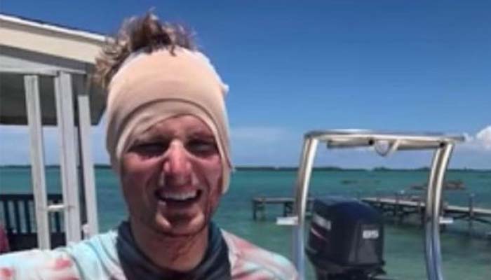 Featured image for Man’s Extroadinary Escape From Shark Who Took Bite Out of His Head Caught on Camera