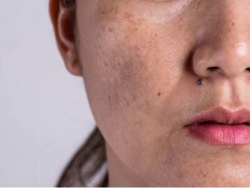 Dark Spots and Pigmentation on Face