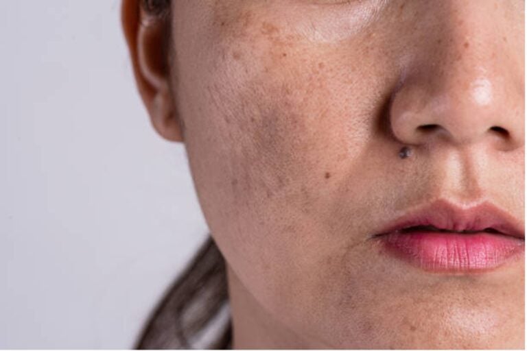 Dark Spots and Pigmentation on Face